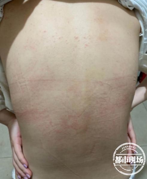 密集恐惧症导致全身瘙痒,密集恐惧症身体发痒