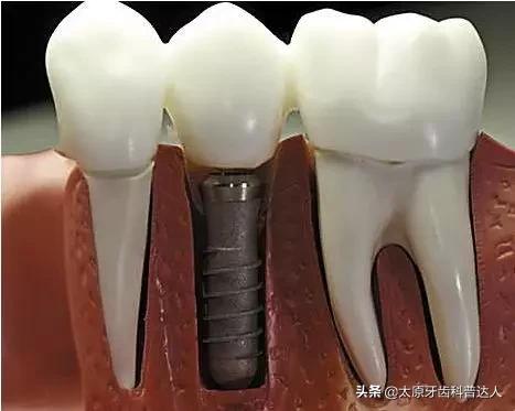 活动假牙和种植牙的性价比,门牙缺失种植牙好还是活动假牙好