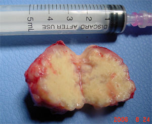 脑包虫病手术与治疗,牛羊脑包虫病治疗方法