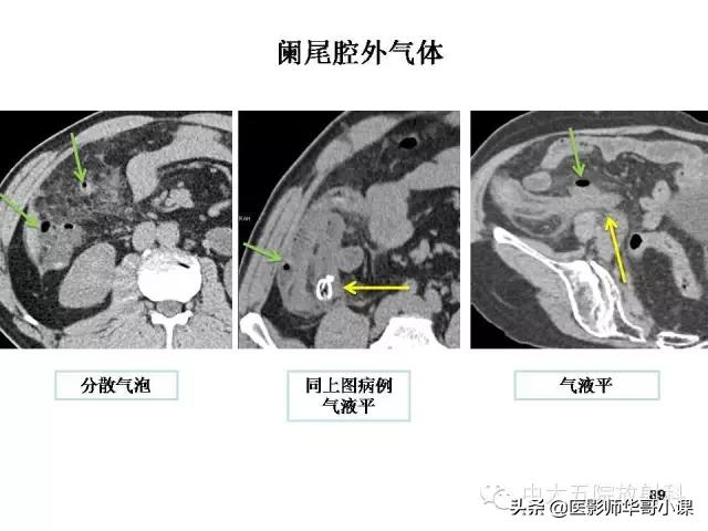 阑尾炎课件,阑尾炎的超声课件