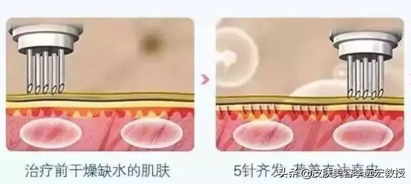 婴儿针是微针还是水光,bb针和水光针的区别