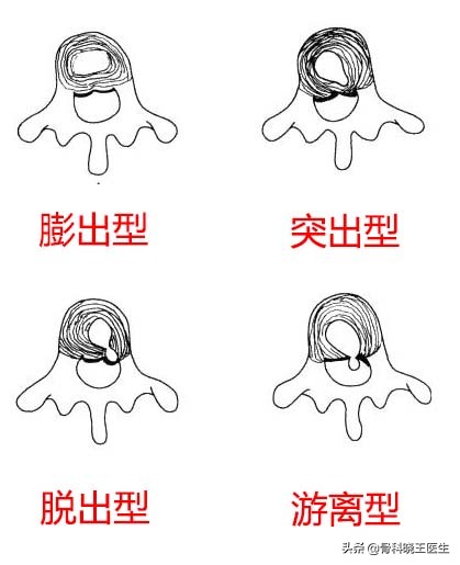 腰间盘突出脚麻腰疼怎么解决,腰间盘突出腰疼的不能动怎么办