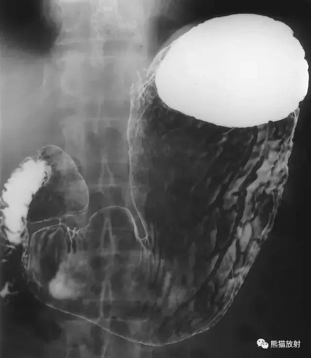「收藏」11种消化道造影解剖图谱