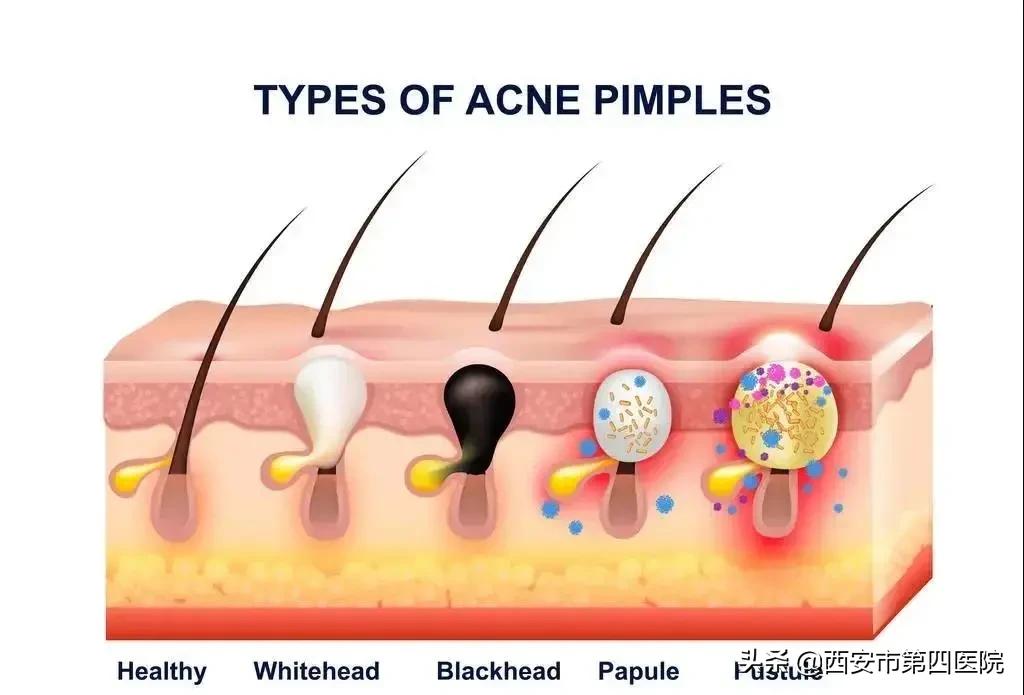 脸上毛孔大靠什么医美解决,毛孔粗大如何正确护肤