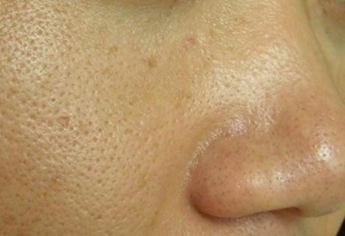 皮肤粗糙显老用什么护肤,皮肤粗糙应该怎么护肤