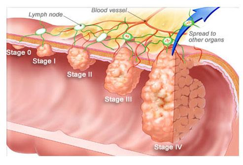 大便粘腻粘稠拉不净是大肠湿热吗,大便拉不干净总有便意感还出血
