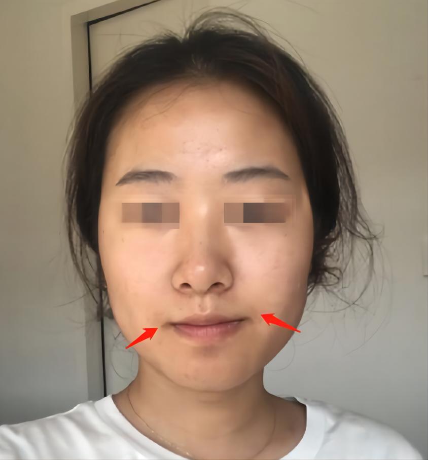 改善脸不对称,面部不对称的脸应该如何改善