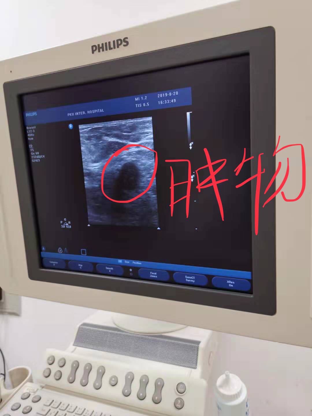 “小护”详解乳腺穿刺活检术，让您不再恐惧这项重要检查