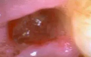 拔牙后出现干槽症怎么办,拔牙干槽症治疗