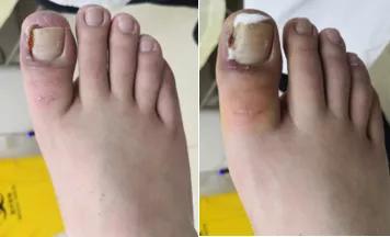 脚食指甲沟炎修甲过程,掌健识健康百科