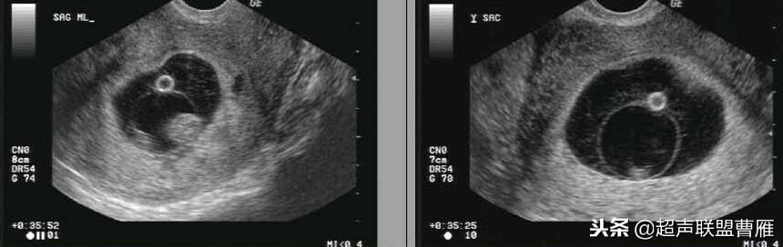 3毫米卵黄囊未见胎芽正常么,40多天的卵黄囊