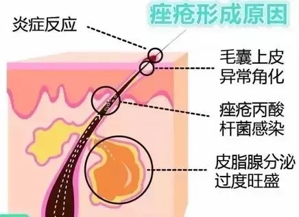 果酸换肤祛痘坑,果酸换肤治痘坑最好的产品