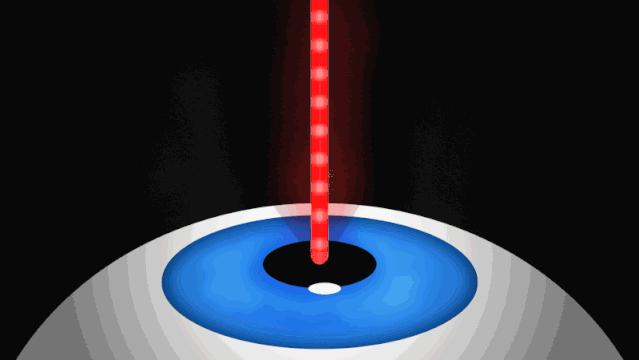 近视icl手术术前术后注意事项,icl近视手术详细过程