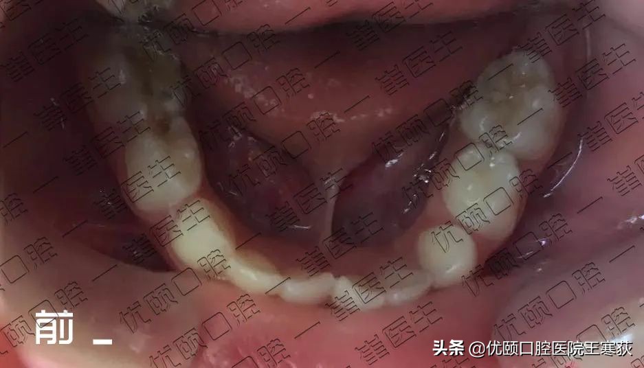 儿童全麻治疗过程,三岁宝宝根管治疗全麻有危害吗