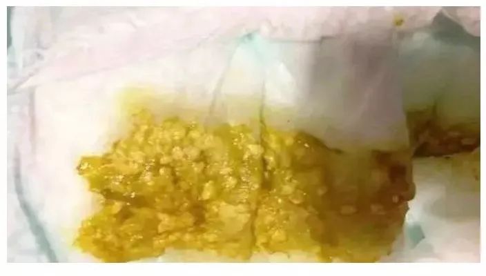 怎样判断新生儿宝宝大便是否正确,新生儿宝宝大便怎么判断是否正常