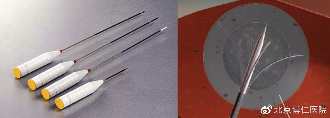 有关肝癌介入治疗的文章,肝癌早发现科普