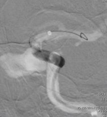 颈内动脉c3段动脉瘤是什么症状,右颈内动脉c3段动脉瘤是什么意思