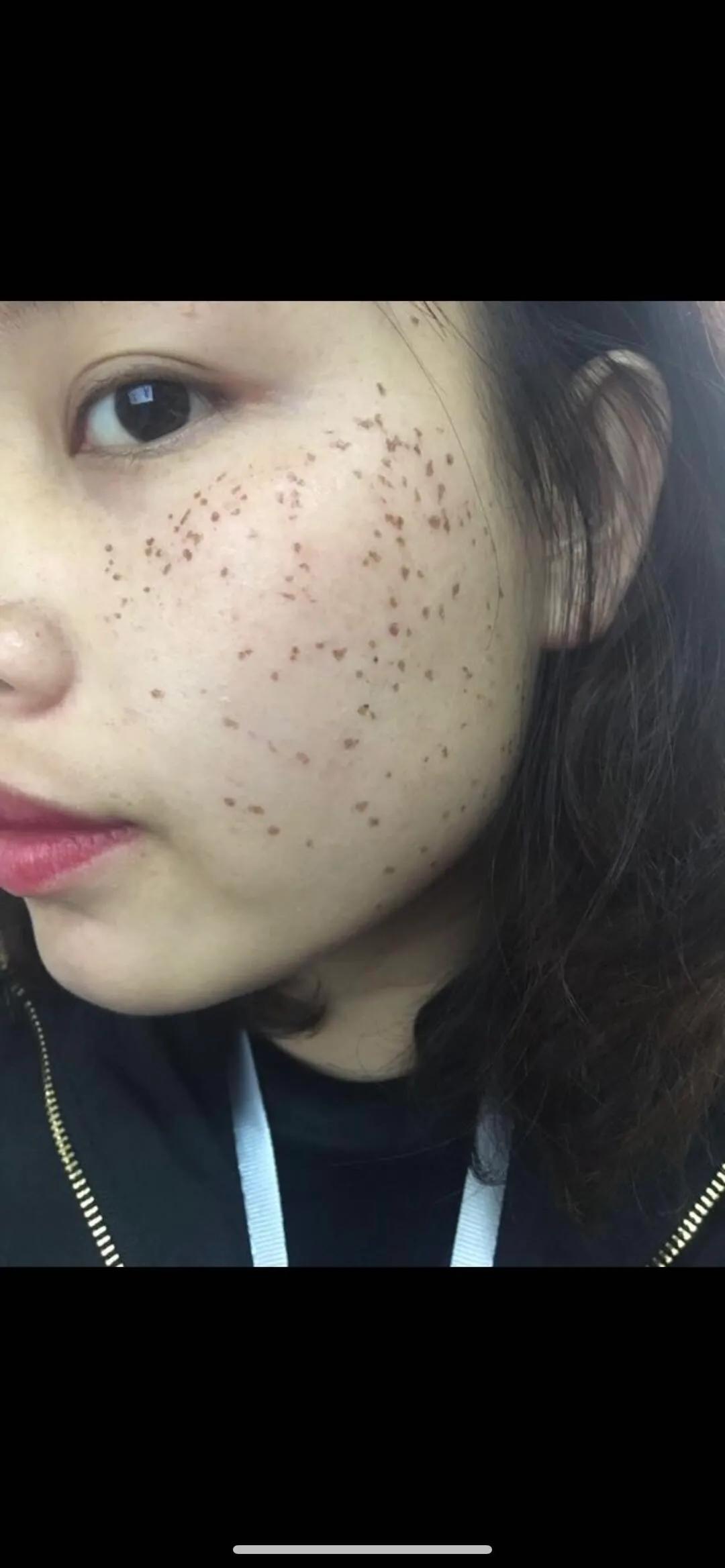 遗传性雀斑食疗方法,遗传性雀斑祛斑霜