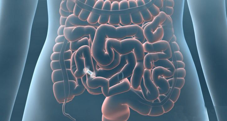 内窥镜胶囊检查效果怎么样,胶囊内窥镜