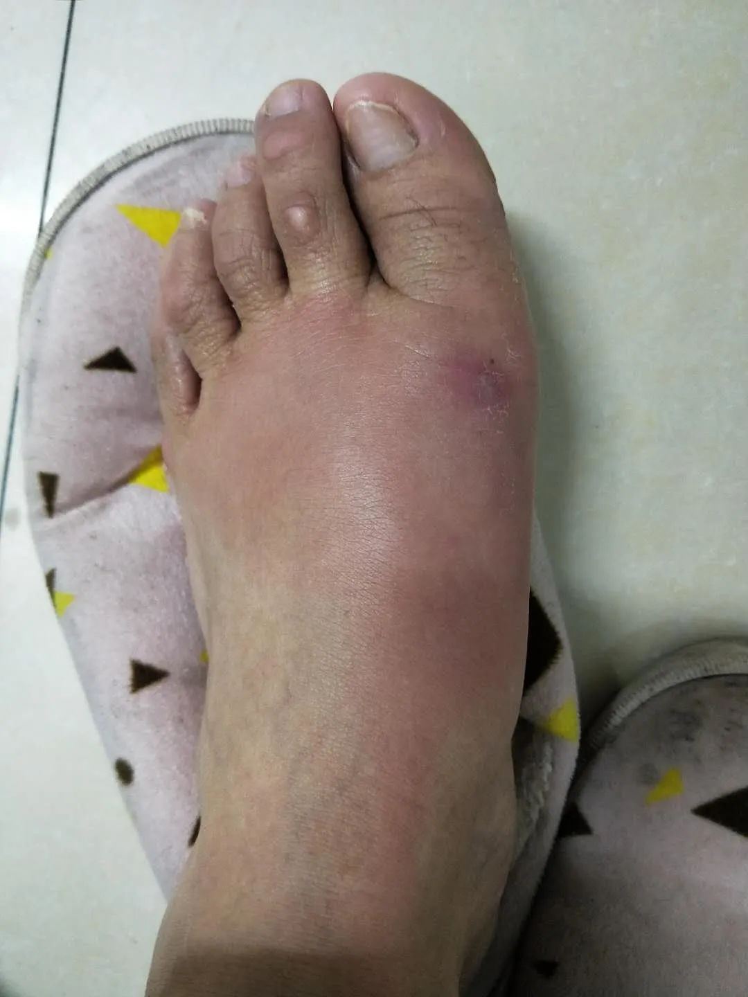 家里治脚气最好的方法,家庭治脚气的最好方法