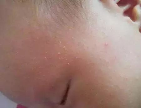 痱子粉和痱子粉的区别,痱子用药皂还是肥皂