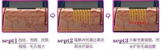 脸上红血丝不用护肤品怎么解决,脸上有红血丝用什么腮红