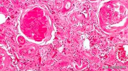 第一例新型冠状病毒遗体解剖真相,新型冠状病毒肺炎人体解剖