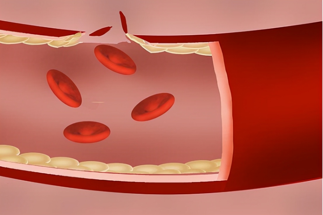 36岁高血压能长期服用降压药吗,突发性高血压需要长期吃降压药吗