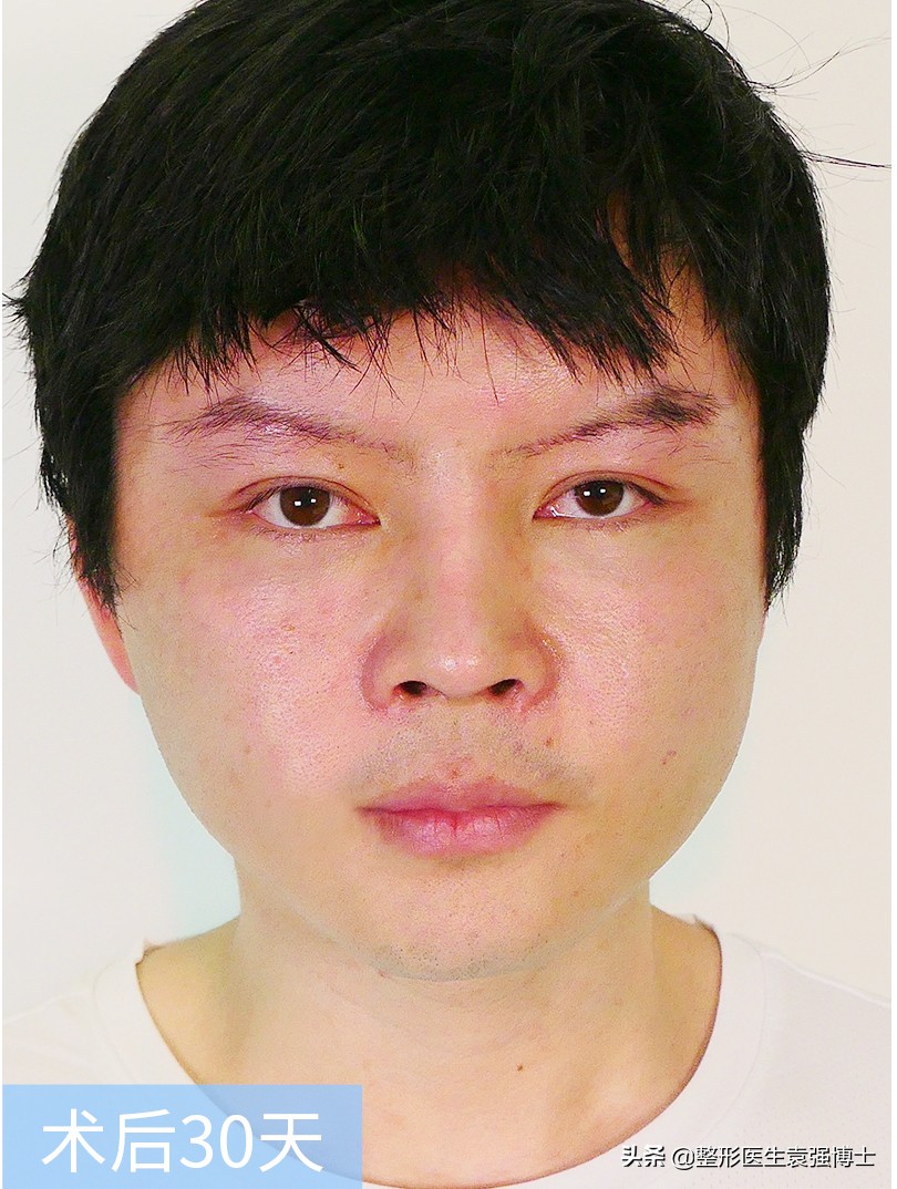 30岁小拉皮手术后7天照片,30岁拉皮恢复过程图片
