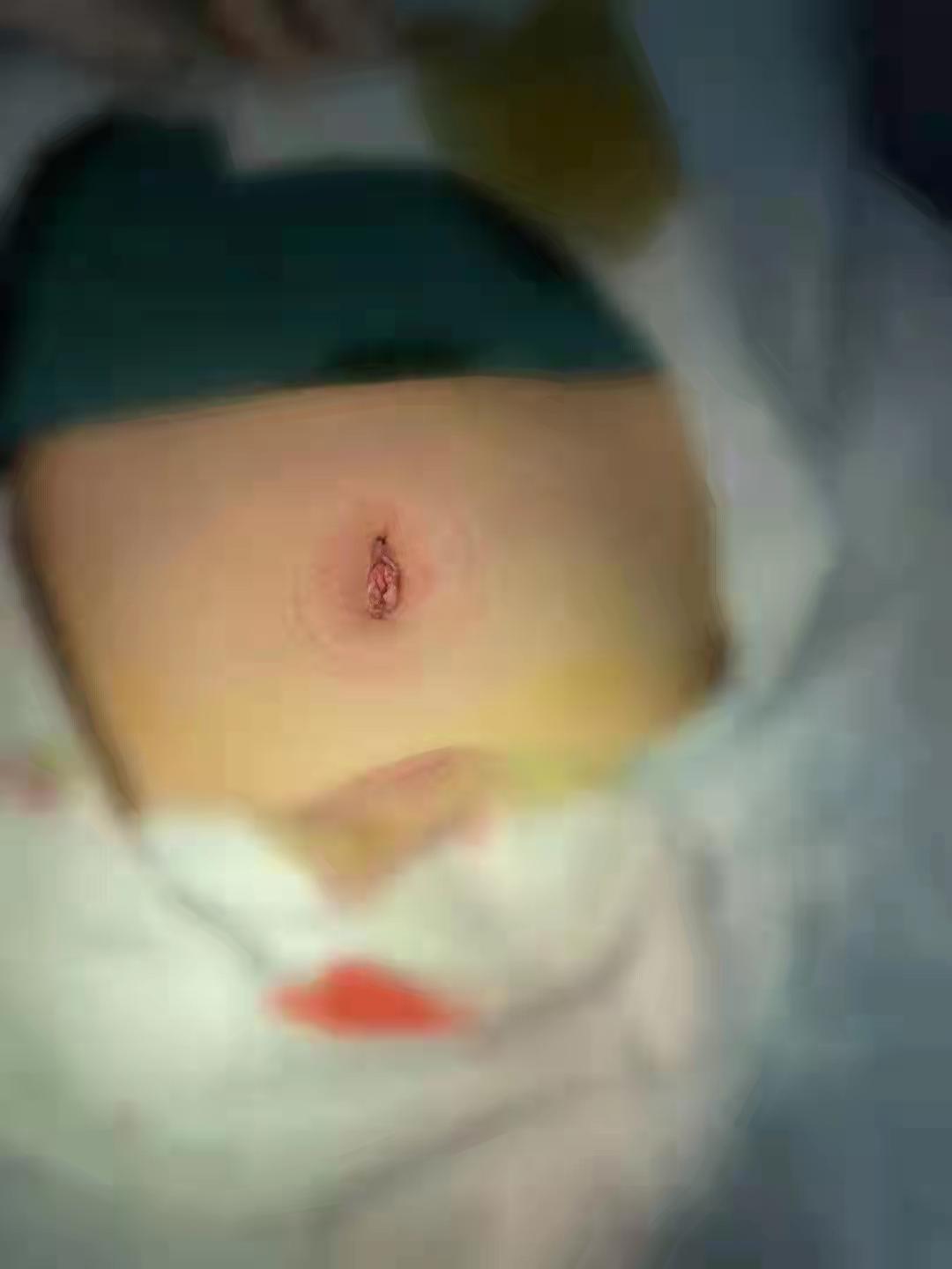 子宫肌瘤6公分,女朋友查出子宫肌瘤我该怎么做