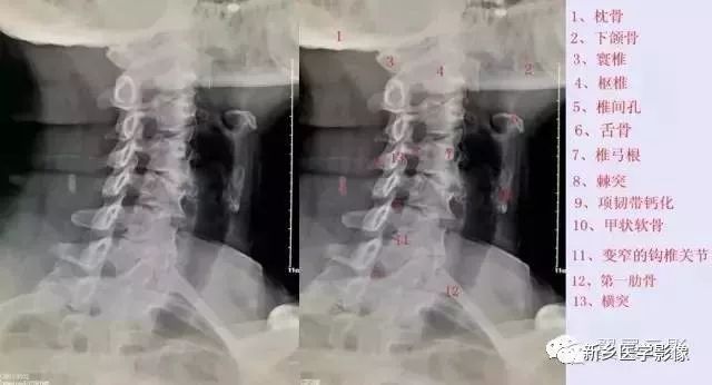 肘关节x线解剖,颈椎x线图片与讲解大全