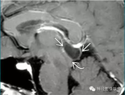 各种囊肿的症状,颅内囊肿18-19mm严重吗