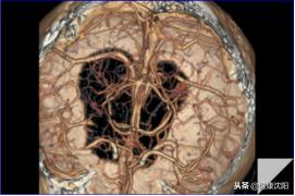 cta和血管造影怎么选择,血管oct检查与血管造影检查的区别