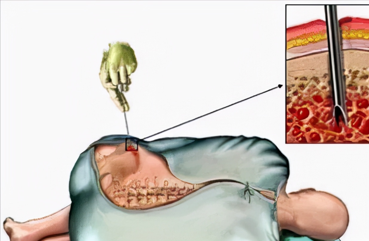 白血病需要做什么检查才能确诊,白血病确诊做什么检查