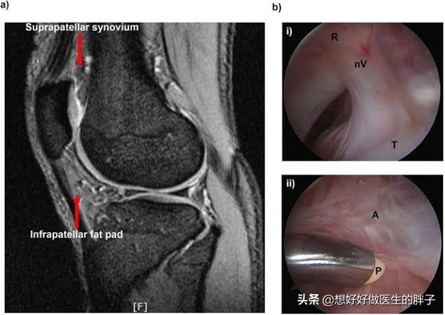 骨折膝关节粘连到哪里康复好,骨折后膝关节粘连怎么锻炼