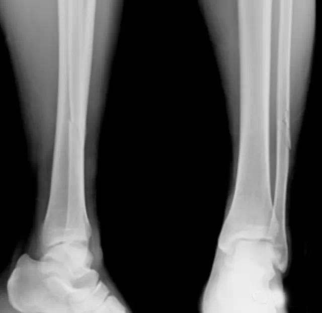 nba球员脚踝骨折恢复,nba篮球运动员脚踝撕脱性骨折