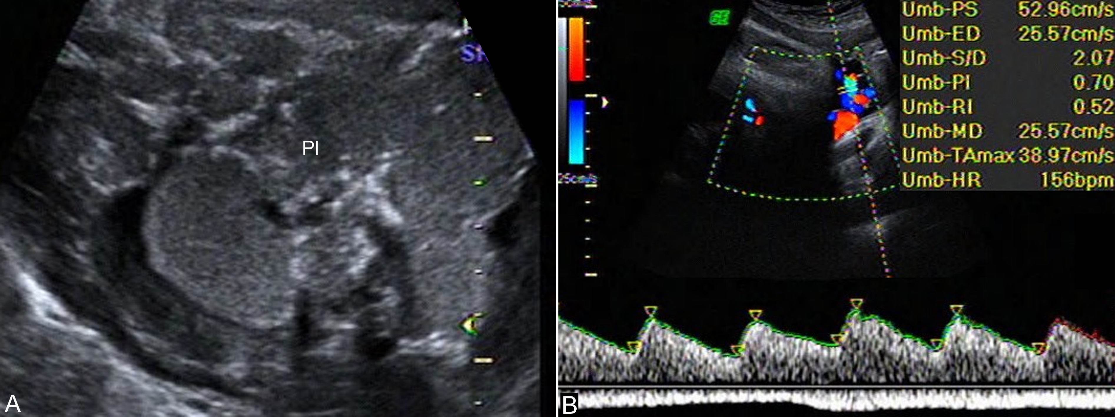 明明白白做b超,中晚期妊娠超声检查