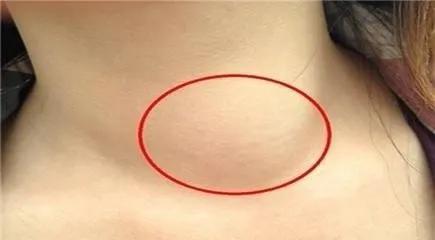 枕后淋巴结单侧肿大不痛不痒不动,下颚淋巴结肿大不痛不痒好几年了