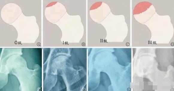 股骨头坏死打孔减压术后恢复多久,股骨头坏死大腿肌肉萎缩能恢复吗