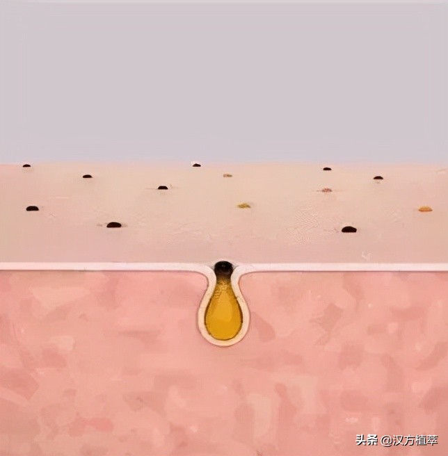 鼻子为什么那么容易长黑头,为什么鼻子最容易长黑头