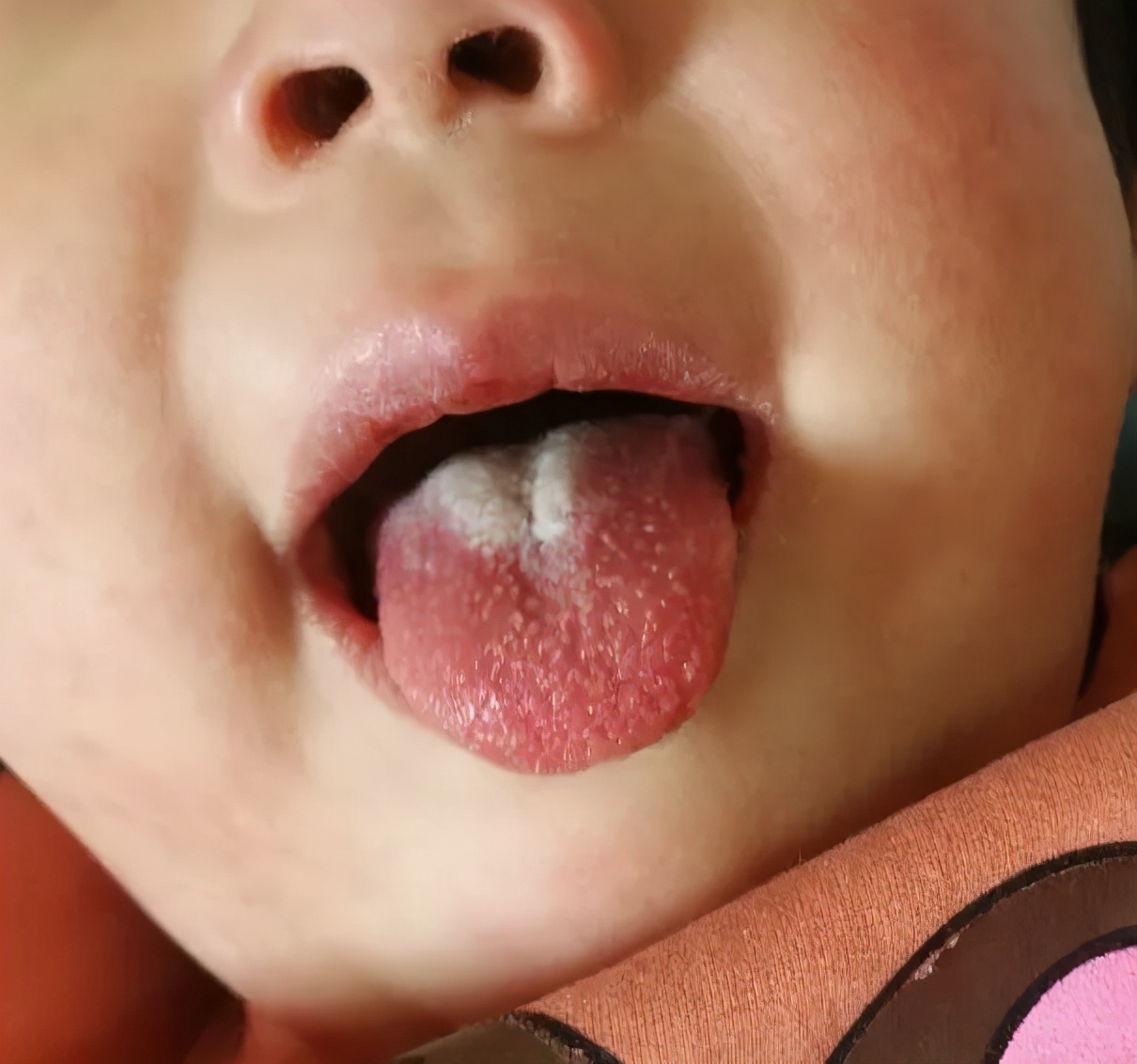 川崎病儿童临床表现,儿童川崎病复发指标