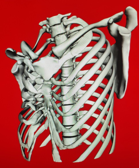 胸廓畸形矫正术后恢复,再创奇迹