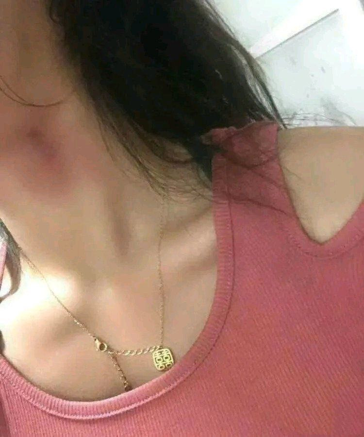 女朋友说她脖子上的红印是吃烤地瓜不小心烫到的，我是不是想多了