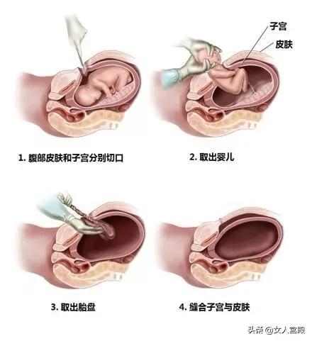 盆底肌很松怎么办,盆底肌松了我该怎么办