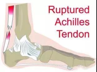 防止小腿肌肉萎缩的康复训练方法,小腿受伤了怎么恢复最快