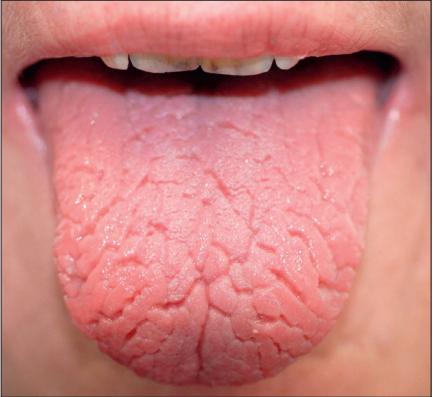 干燥综合症最怕的三种食物,干燥综合症的8大临床特征