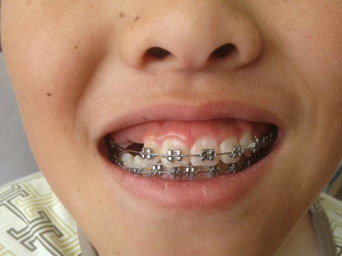 牙齿矫正为啥后期就不怎么痛了,牙齿矫正痛不痛