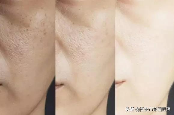 #安心变美课堂##我的安心变美推荐#点阵激光，帮你把被“坑过”的青春平回来！