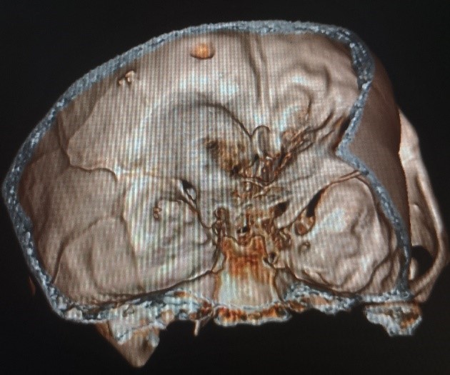 三叉神经痛需要抗癫痫治疗吗,癫痫引起的三叉神经痛怎么治疗