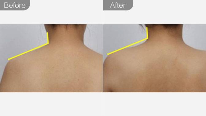 瘦肩针多少钱一针能保持多久,瘦肩针注射视频教程